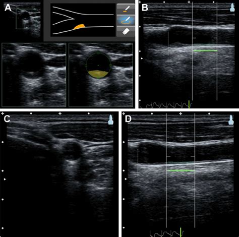 intimal thickening lower extremity ultrasound